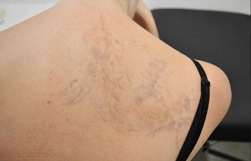 Will tattoo removal leave a scar